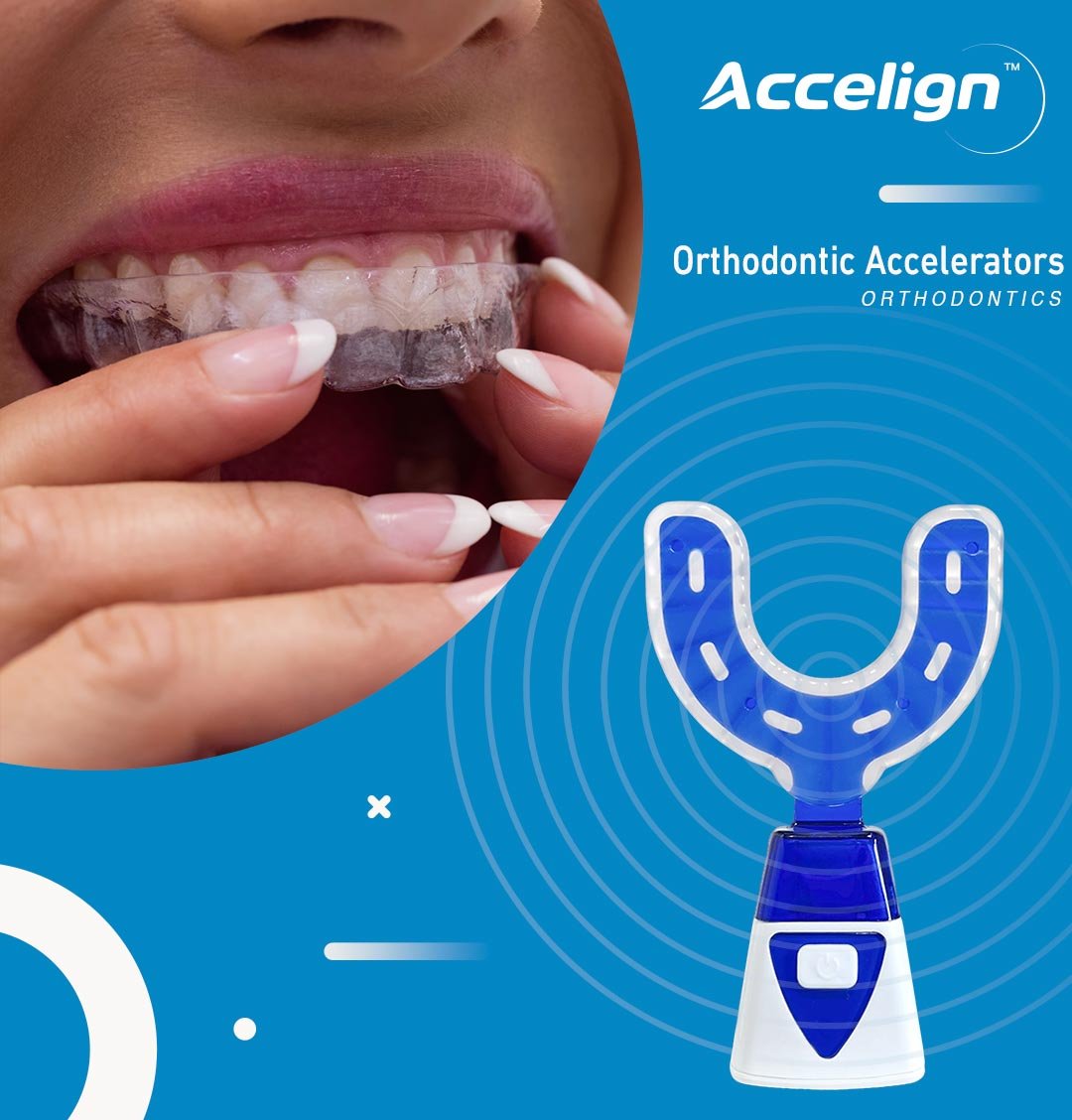 Accelign orthodontic accelerator device in blue and white