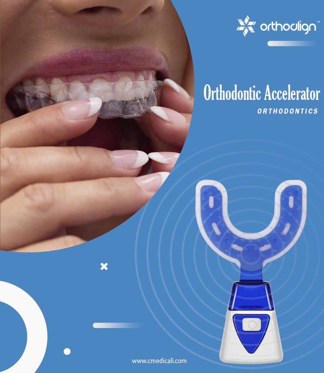 Orthodontic Accelerator|OrthoAlign™ USA|Orthodontic Treatment Aids